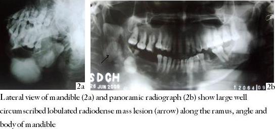 Large well circumscribed lobulated radiodense mass lesion (arrow) along the ramus, angle and body of mandible