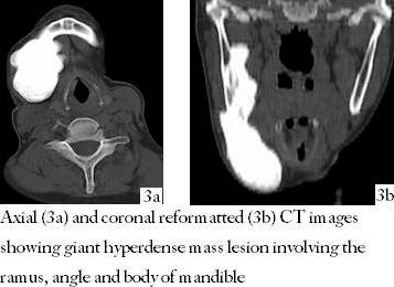 CT images showing giant hyperdense mass lesion involving the ramus, angle and body of mandible