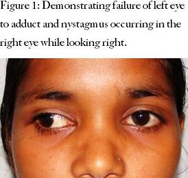 Demonstrating failure of left eye to adduct and nystagmus occurring in the right eye while looking right