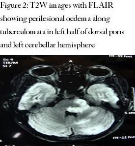 T2W images with FLAIR showing perilesional oedema along tuberculomata in left half of dorsal pons and left cerebellar hemisphere