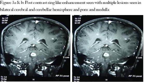 Post contrast ring like enhancement seen with multiple lesions seen in bilateral cerebral and cerebellar hemisphere and pons and medulla