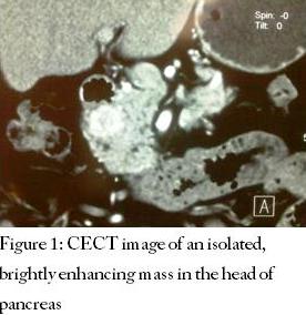 CECT image of an isolated, brightly enhancing mass in the head of pancreas